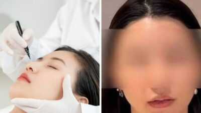 Woman's Botched Plastic Surgery In South Korea Ends In Disturbing Facial Scar