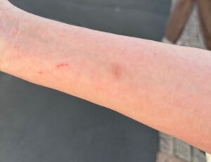 Bruises on fan's arm