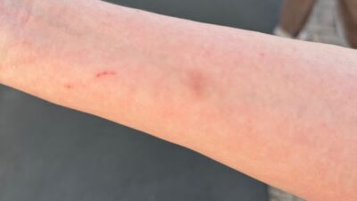 Bruises on fan's arm